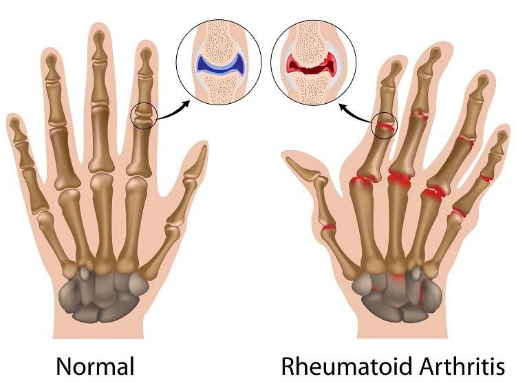 Arthritis