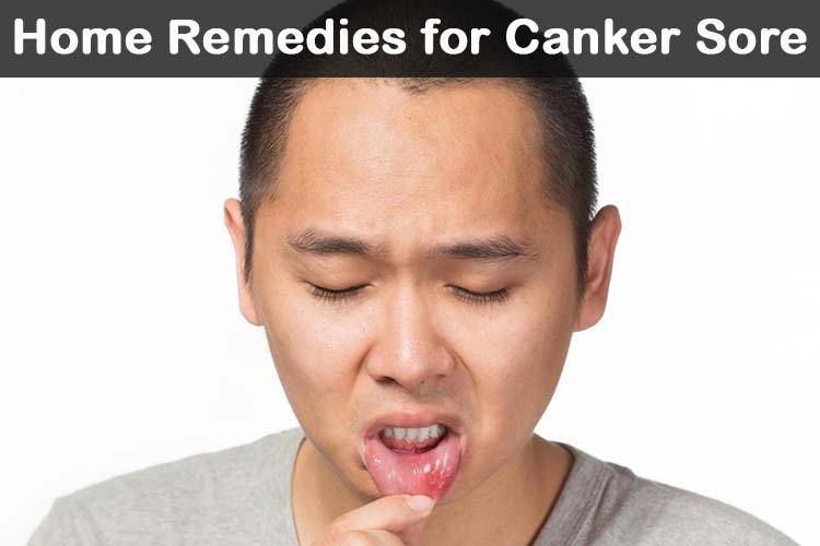 Canker Sore