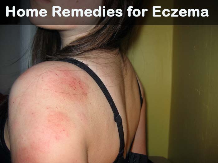 Eczema