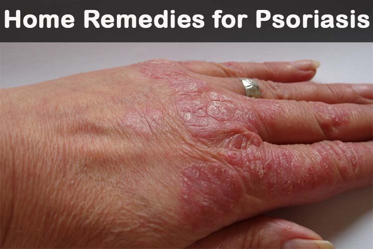 Psoriasis