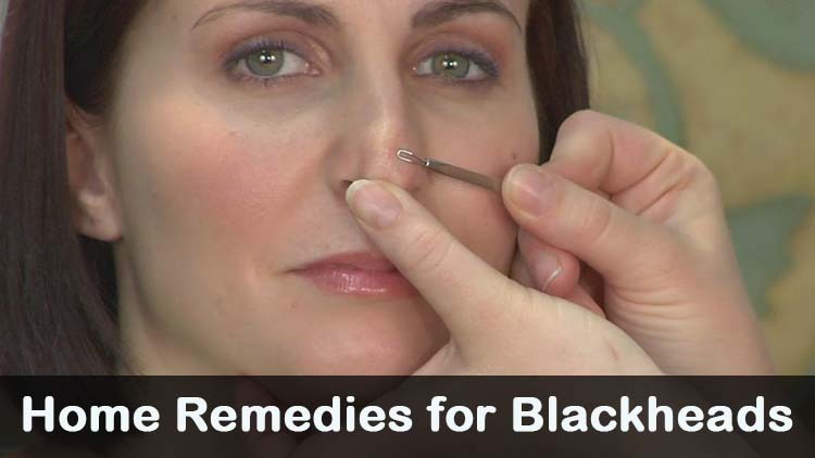 Blackheads