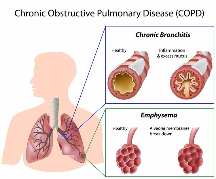 Bronchiectasis