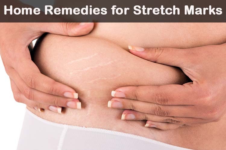 Stretch Marks