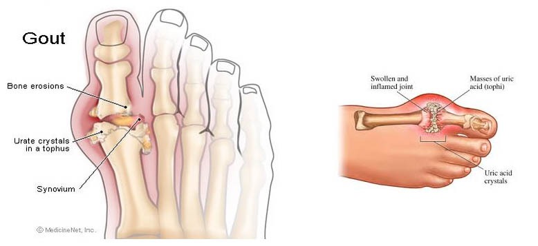 Gout Pain