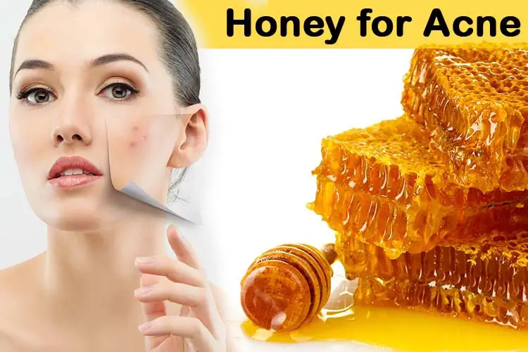 Honey for Acne