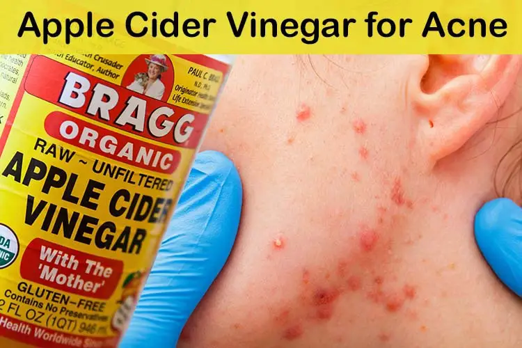 Apple Cider Vinegar for Acne 1