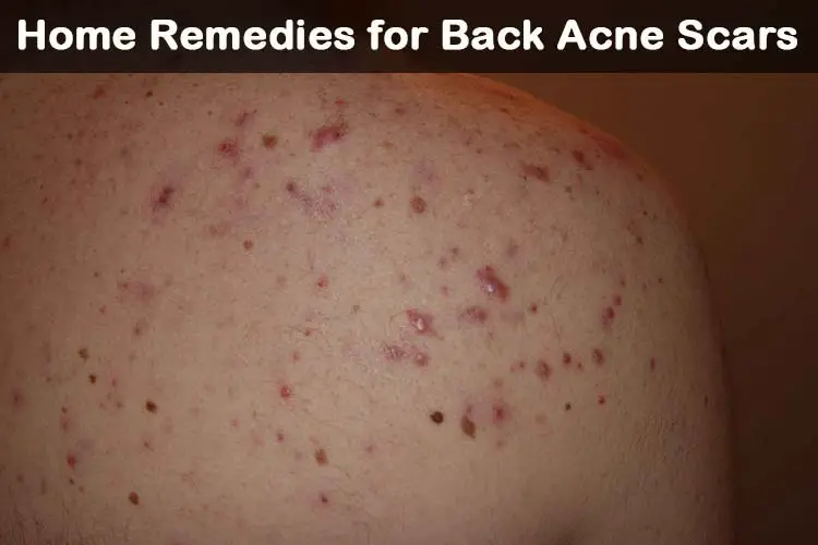 Back Acne Scars