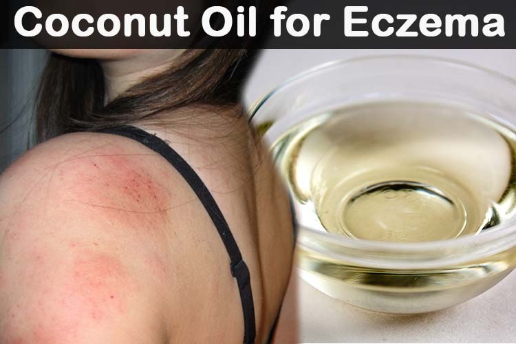 Coconut Oil for Eczema