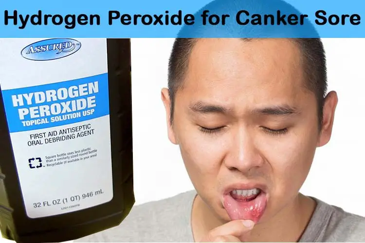 Hydrogen Peroxide for Canker Sore