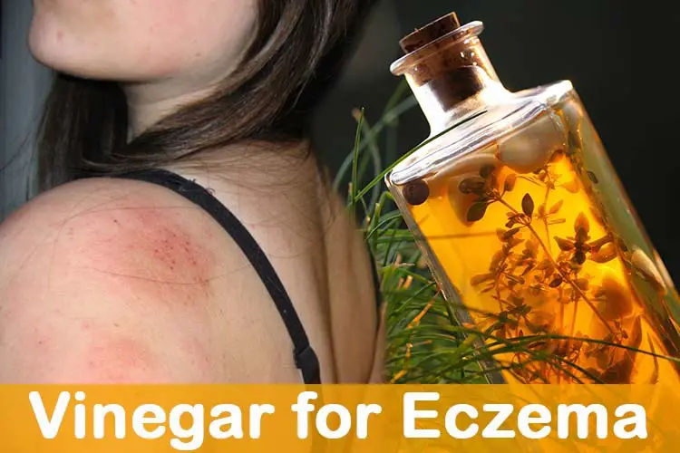 Vinegar for Eczema