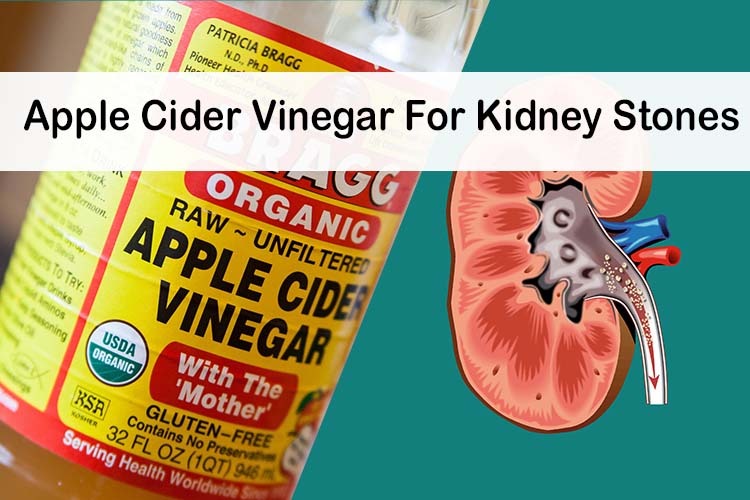 Apple Cider Vinegar for Kidney Stones