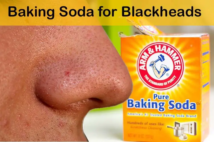 Baking Soda for Blackheads