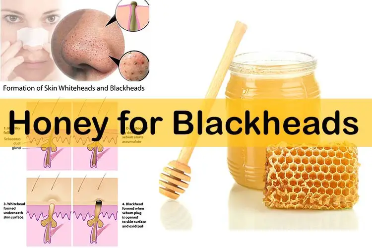 Honey for Blackheads
