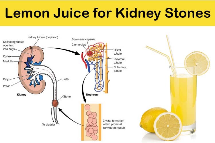 lemon juice for kidney stones