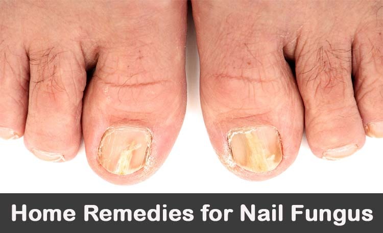 Nail Fungus