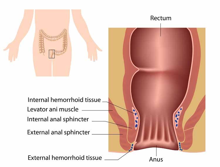 hemorrhoids