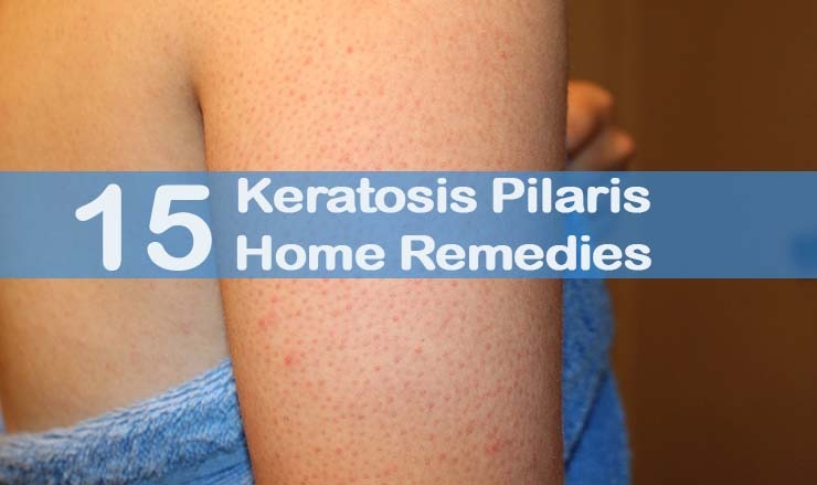 Keratosis Pilaris