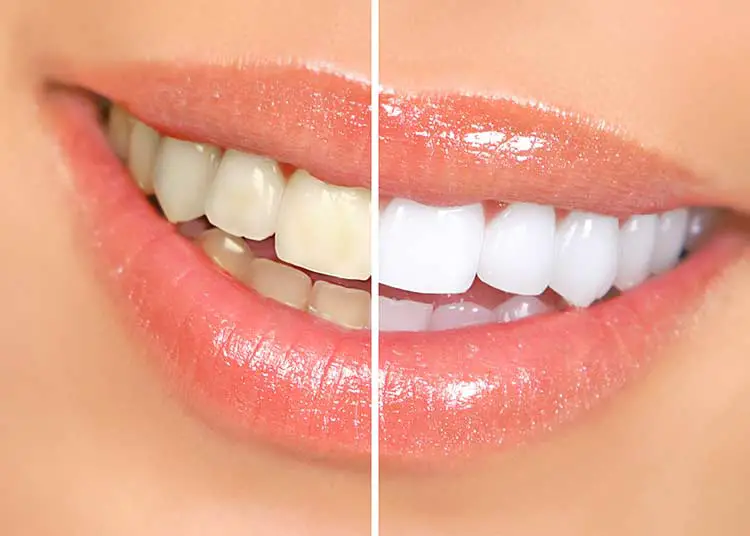 Whiten-Teeth