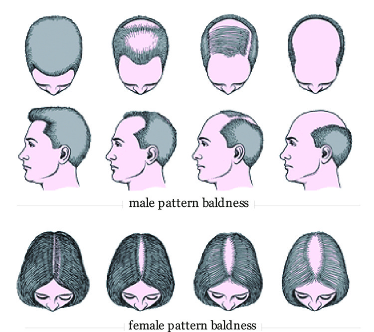 baldness / male and women