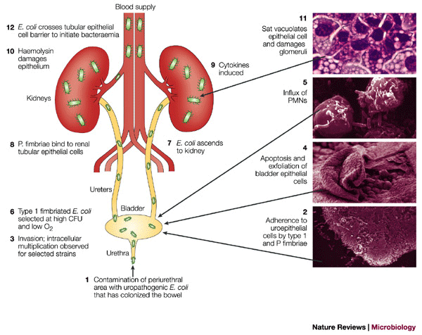 urinary tract infection