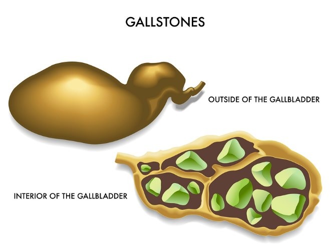 Gallstones