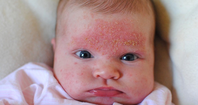 Cradle Cap