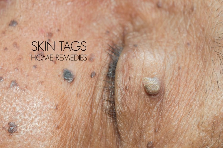 skin tags home remedies