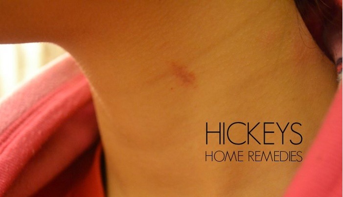 Hickeys