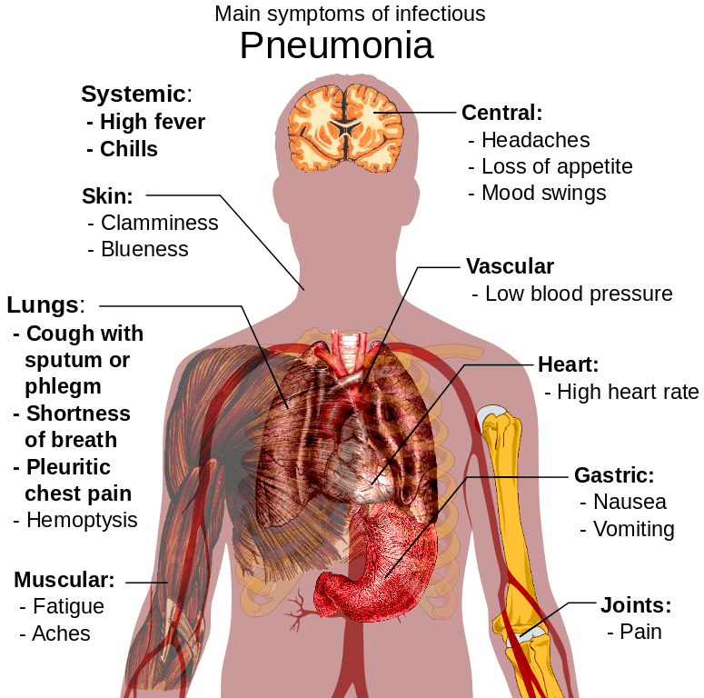 Home Remedies For Pneumonia