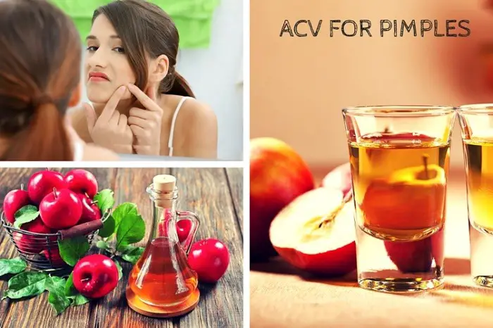 Apple-Cider-Vinegar-For-Pimples