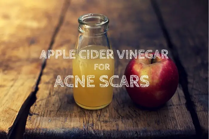 apple cider vinegar for acne scars