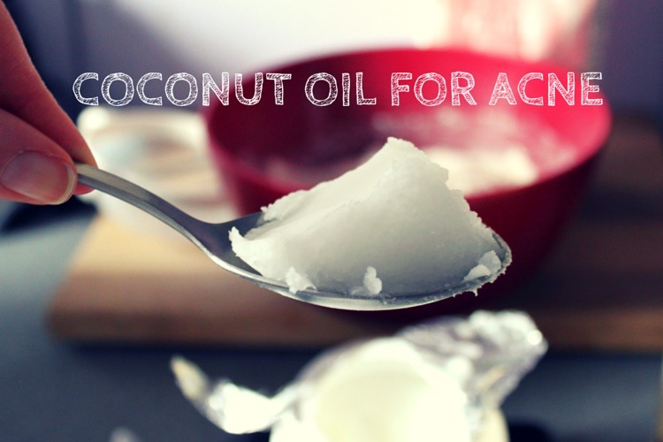 coconut oil for acne