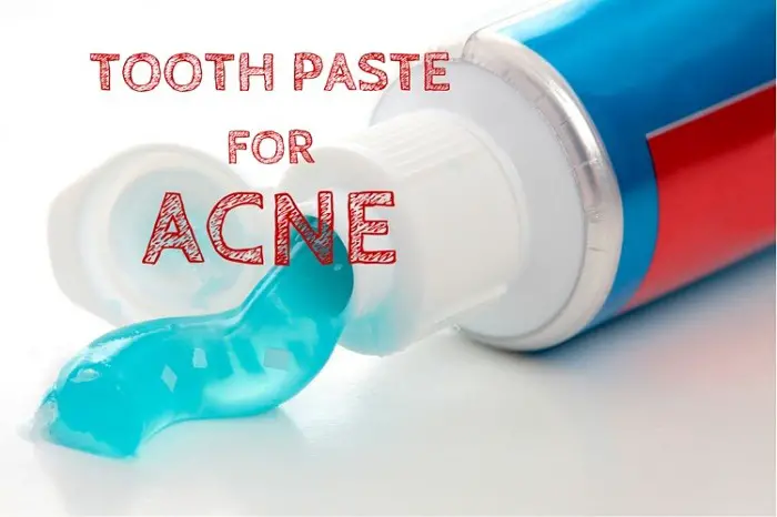 toothpaste for acne