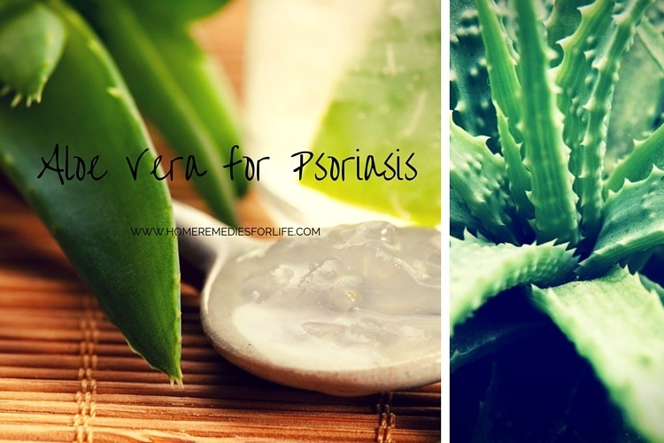 Aloe vera for psoriasis