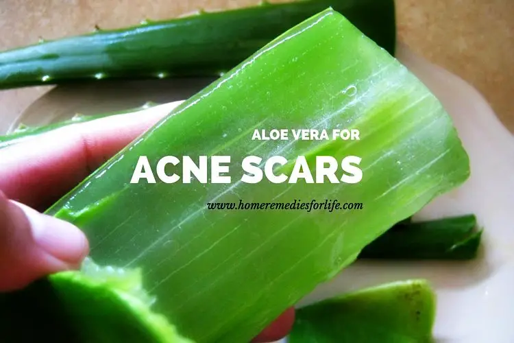 Aloe vera For acne scars