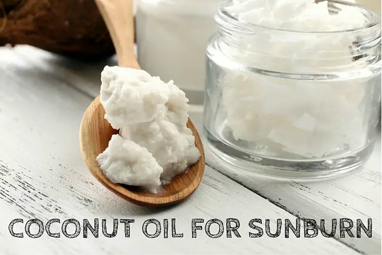 Coconut oil for sunburn