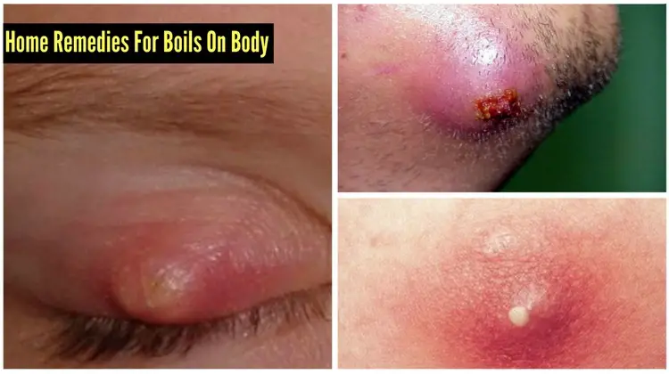 Home Remedies For Boils On Body