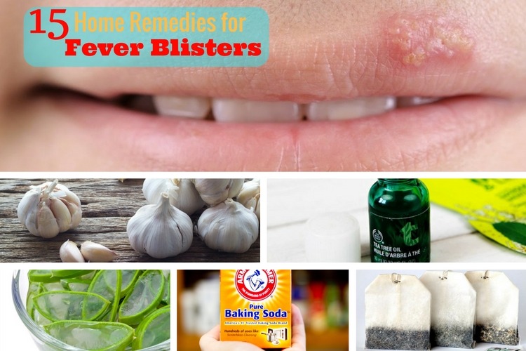 Home Remedies For Fever Blisters