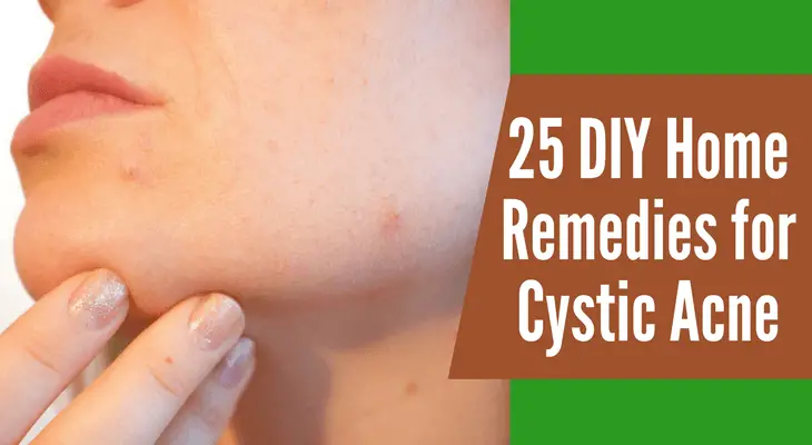 25 DIY Home Remedies for Cystic Acne