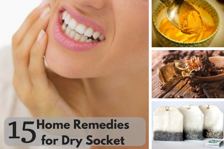 Home Remedies For Dry Socket