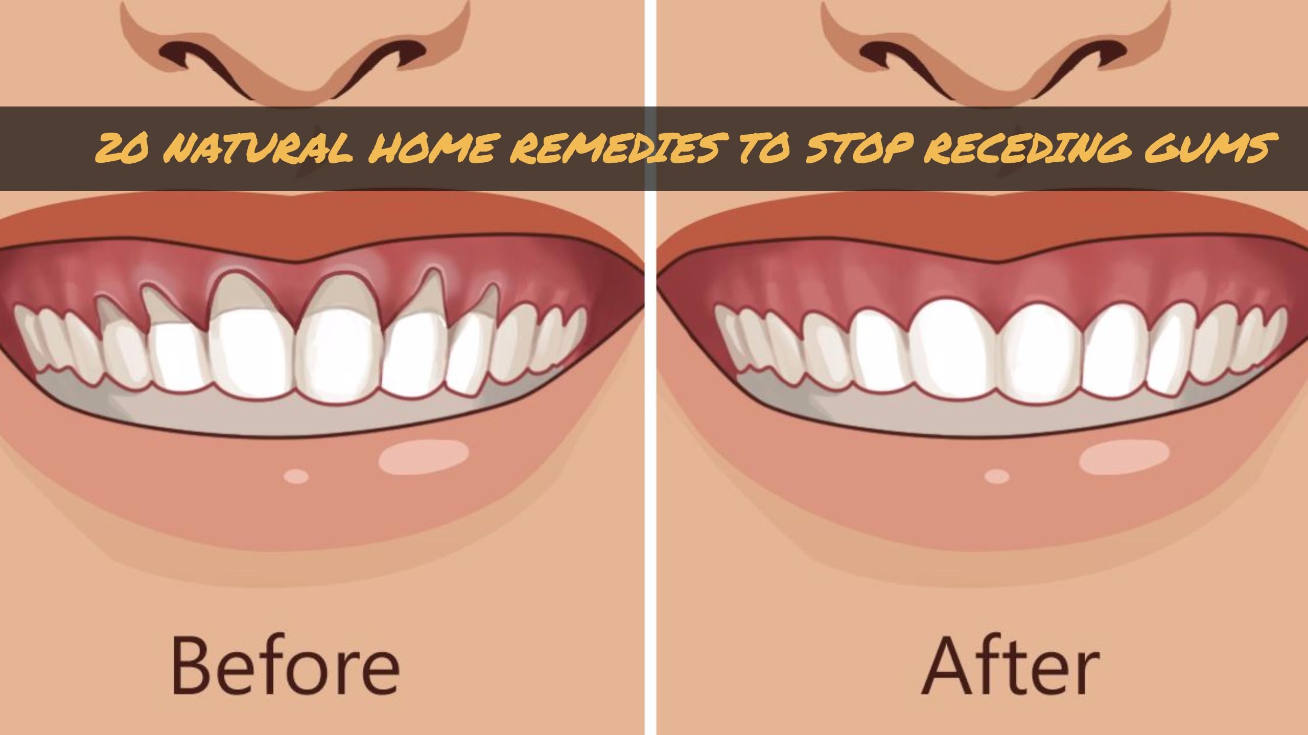 Home Remedies for receding gums