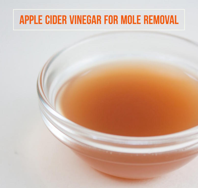 Apple Cider Vinegar For Mole Removal