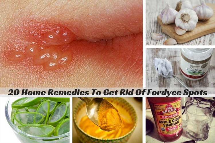Fordyce Spots On Lips Treatment Apple Cider Vinegar And Honey