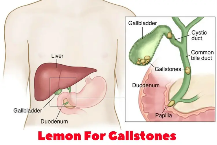 Lemon For Gallstones