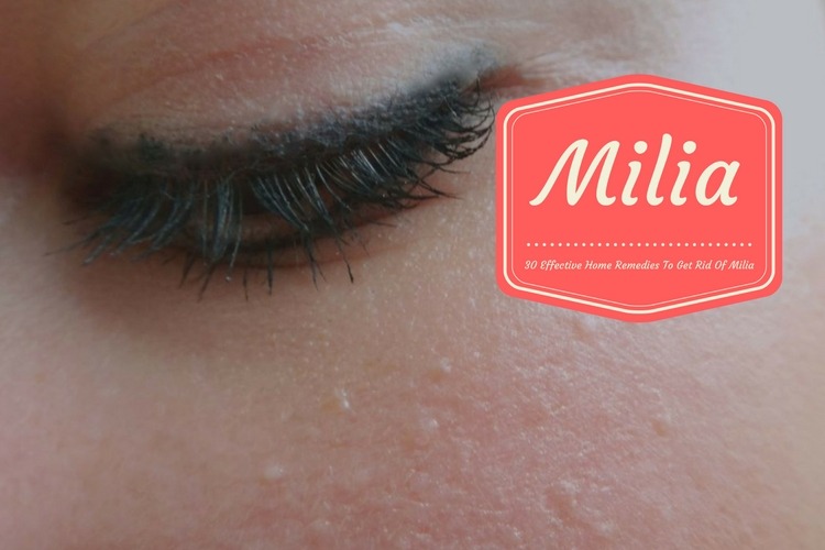 How to Get Rid of Milia Using Home Remedies