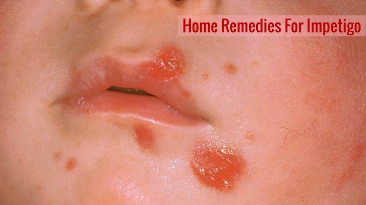 18 Home Remedies To Get Rid Of Impetigo Fast Wellnessguide