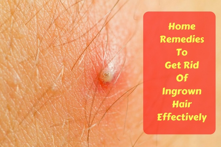 23 Home Remedies To Get Rid Of Ingrown Hair Effectively Wellness.guide