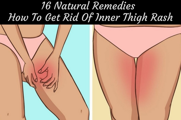 Home Remedies to Get Rid of Inner Thigh Rash