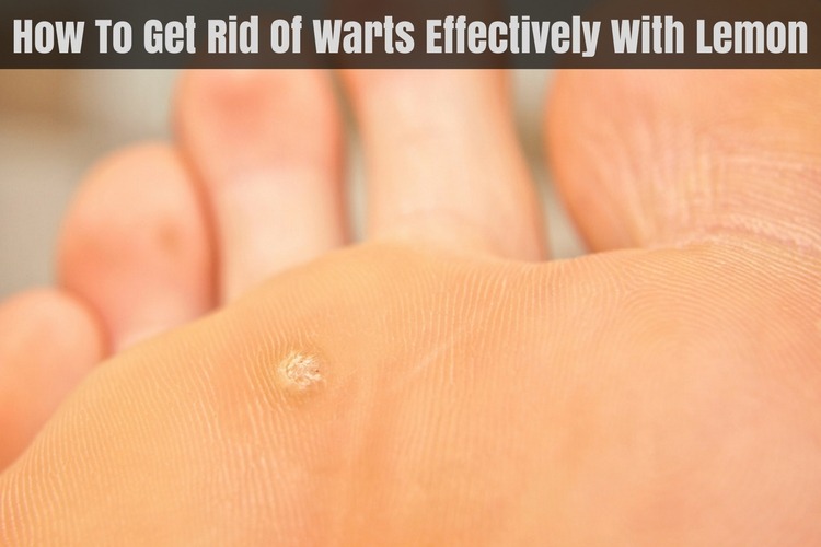 How to Use Lemons for Warts