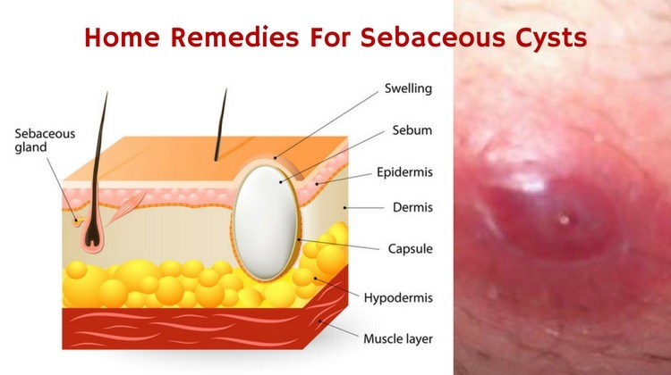 Sebaceous Cysts